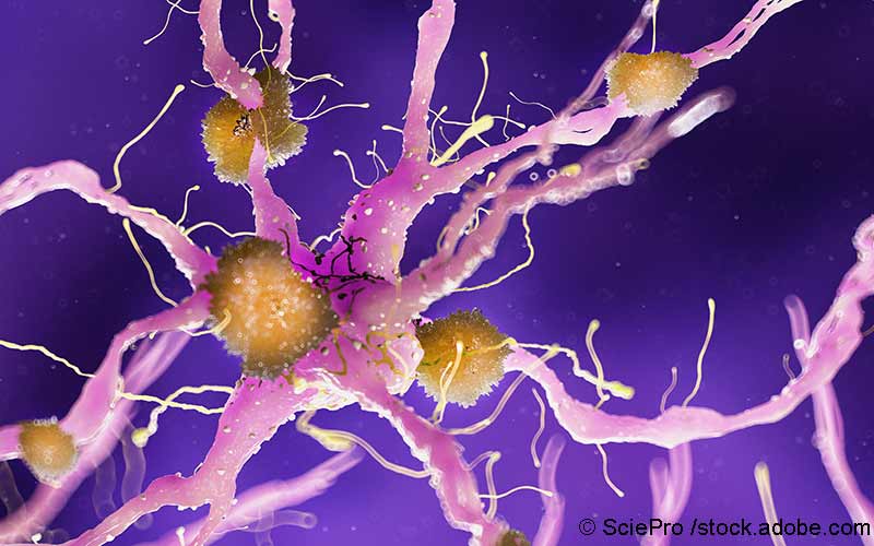 Amyloidablagerung Alzheimer Amyloidablagerung Alzheimer