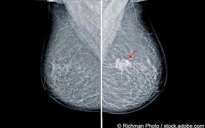 Brustkrebs Mammographie Brustkrebs Mammographie