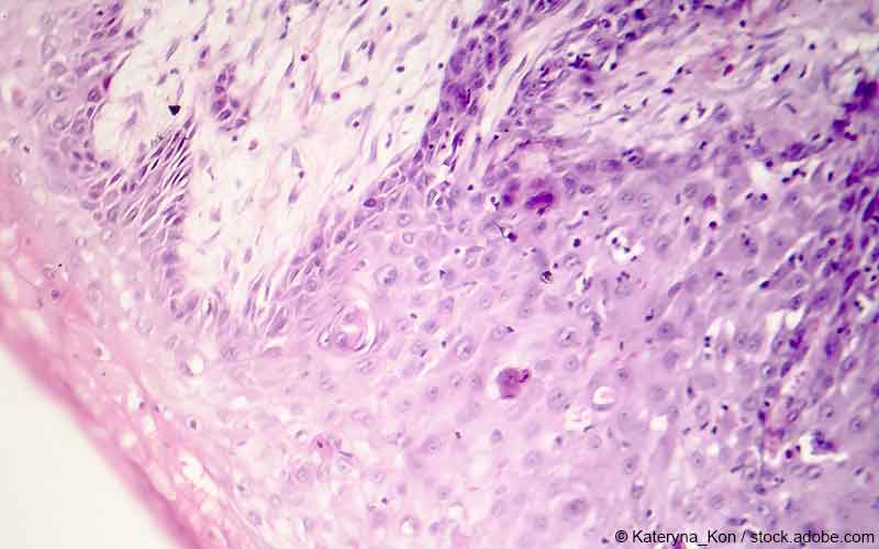 Kutanes Plattenepithelkarzinom