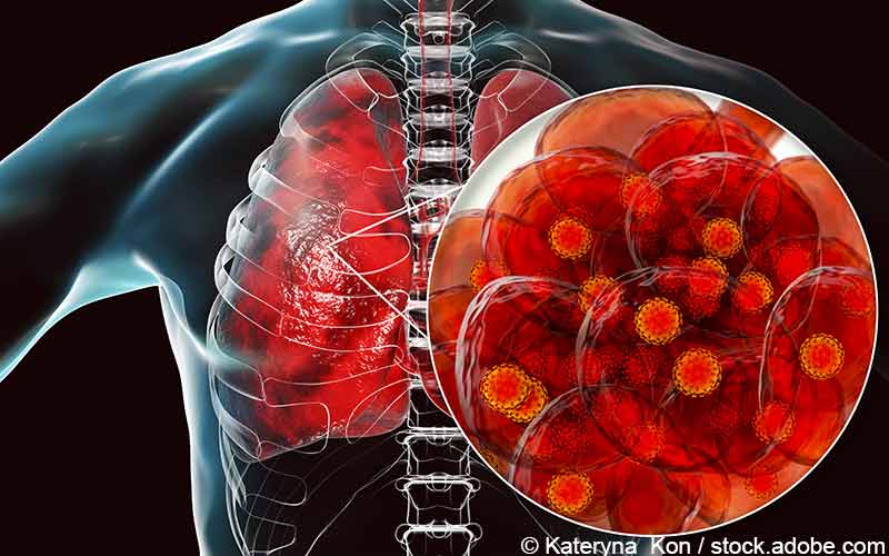 SARS-CoV-2-Lungenschäden
