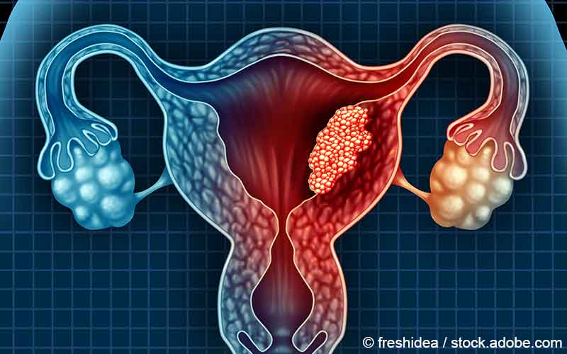 Uteruskarzinom Uteruskarzinom