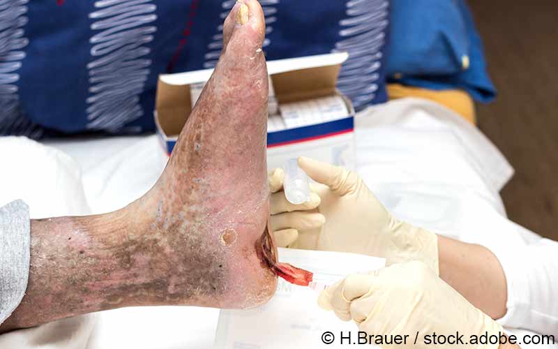Behandlung Diabetischer Fuß Behandlung Diabetischer Fuß