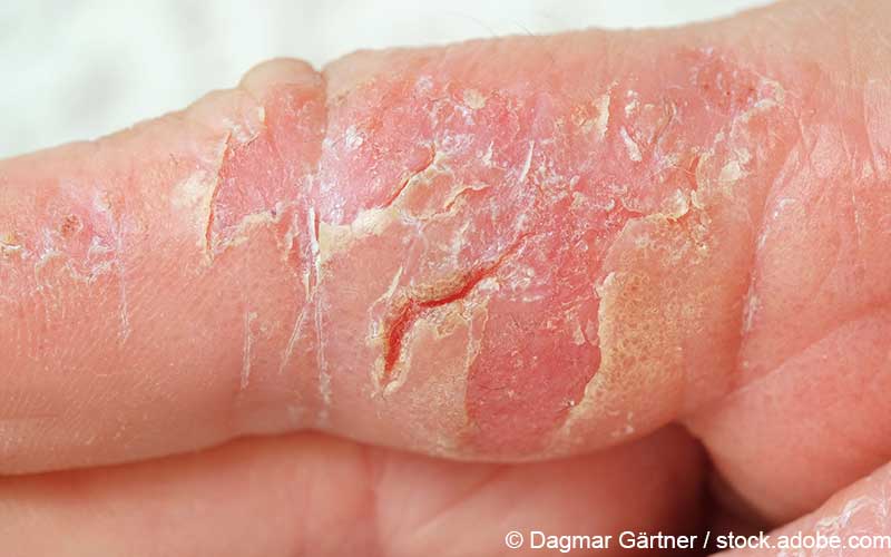 Atopische Dermatitis Detailaufnahme