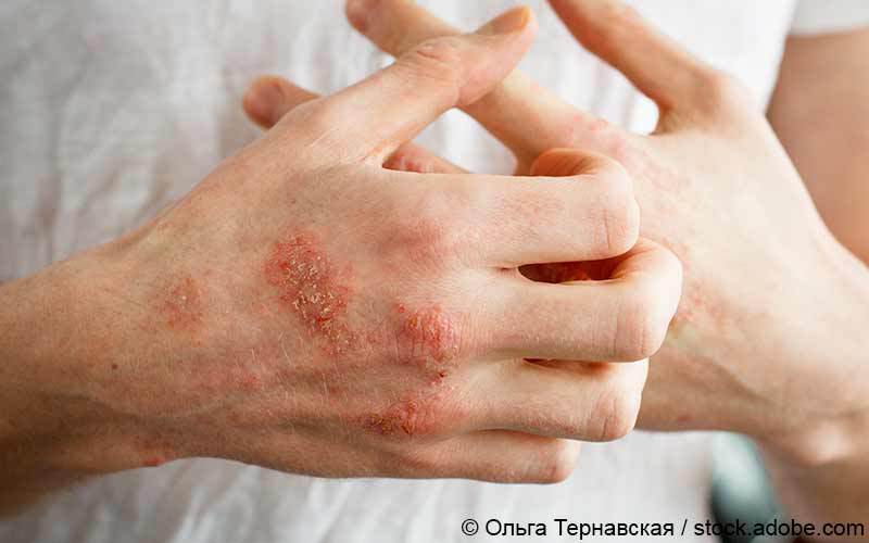 Atopische Dermatitis Hand