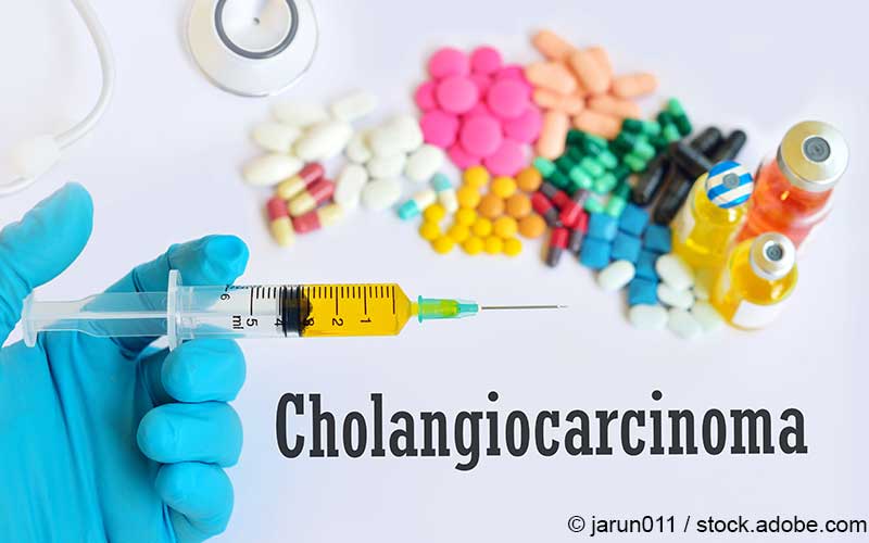 Cholangiokarzinom