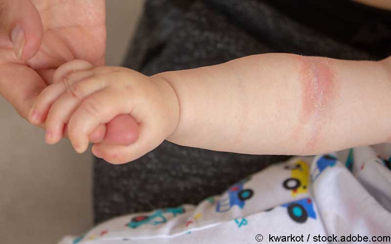 Atopische Dermatitis Gendefekt Schon Bei Babys Bemerkbar Gelbe Liste