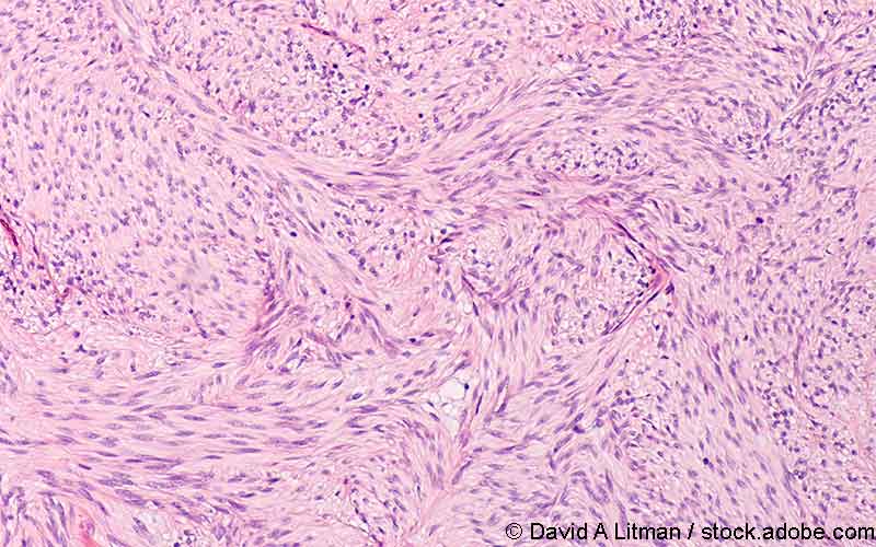 Gastrointestinaler Tumor Mikroskop