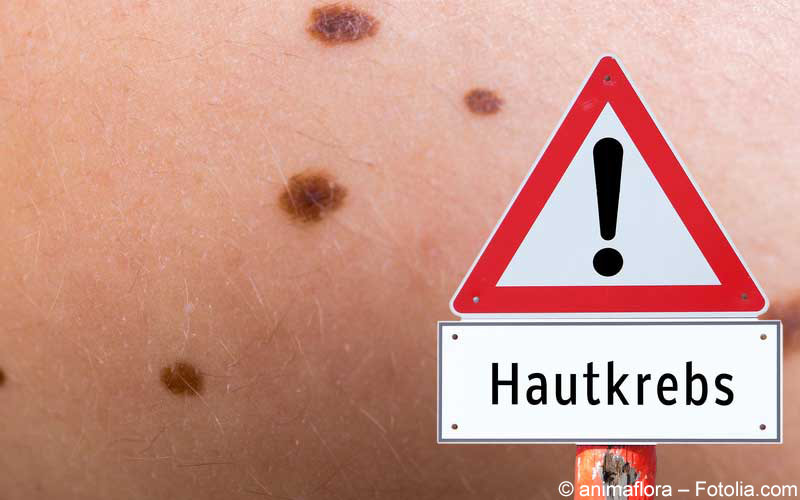 Hautkrebs Hautkrebs