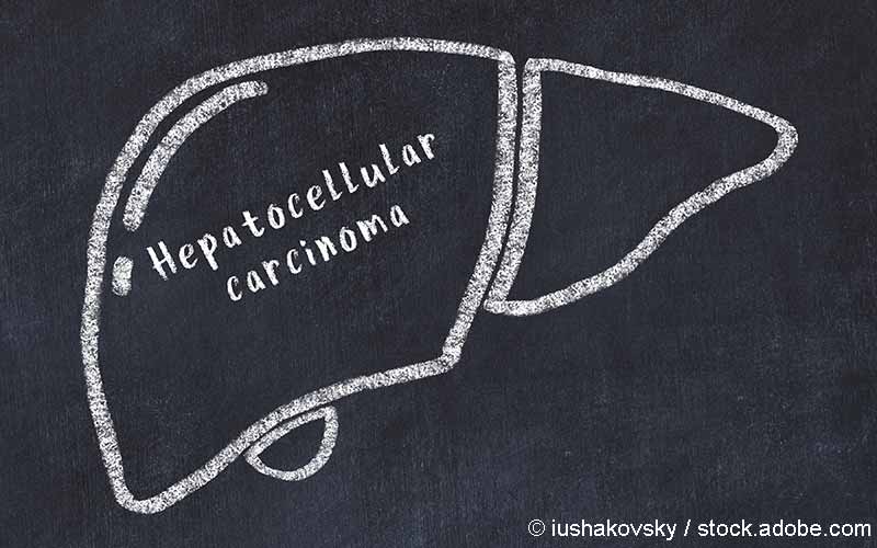 Hepatozellulaeres Karzinom