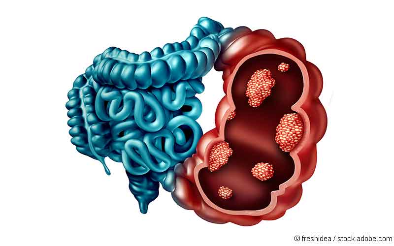 Kolonkarzinom