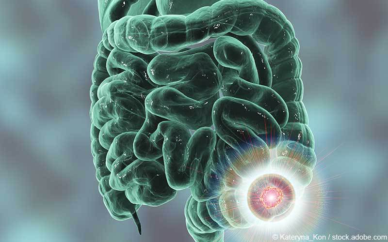 Kolorektales Karzinom