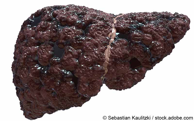 Leberzirrhose