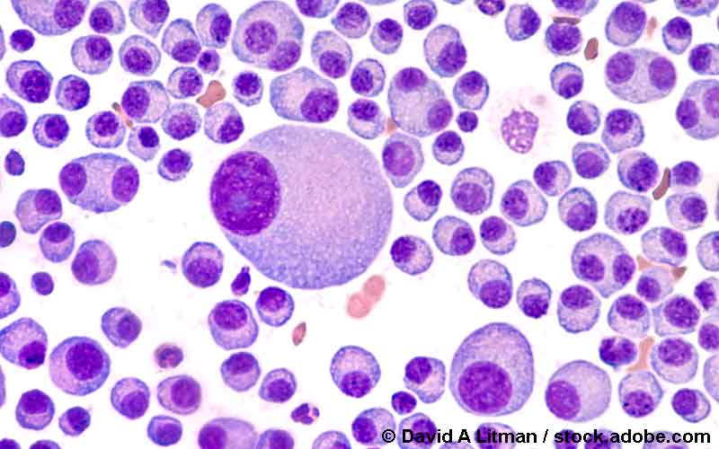 Multiples Myelom2