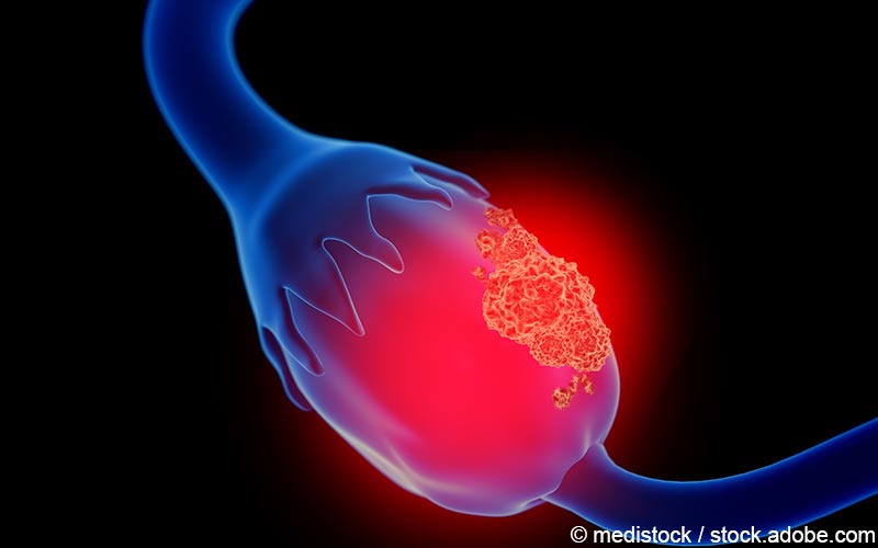 Ovarialkarzinom Eierstock