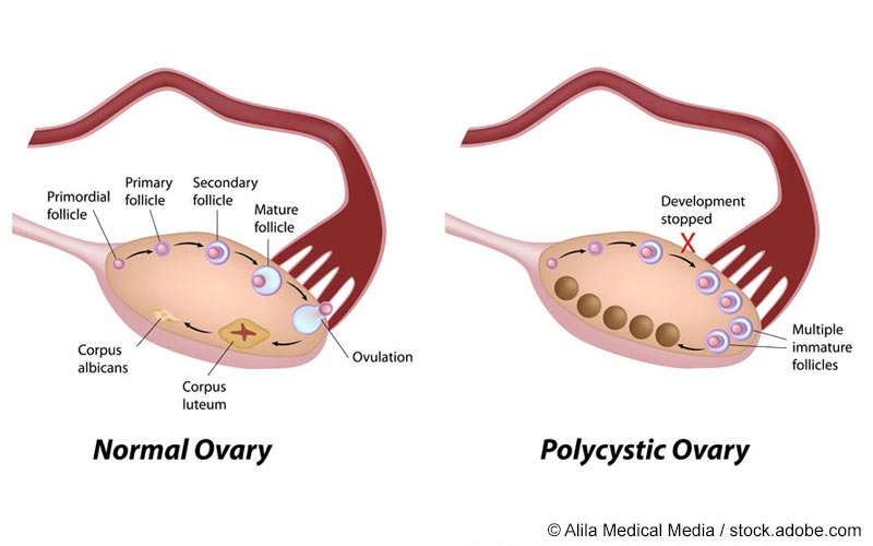 polyzystisches ovar syndrom