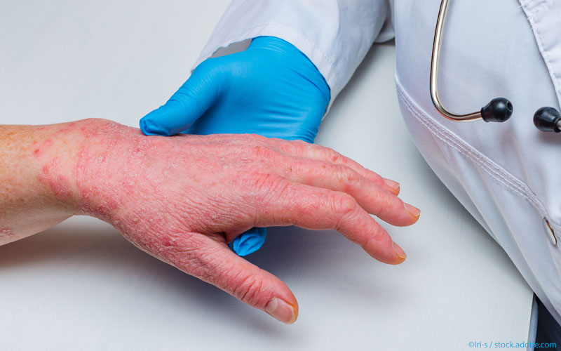 Psoriasis-Arzt
