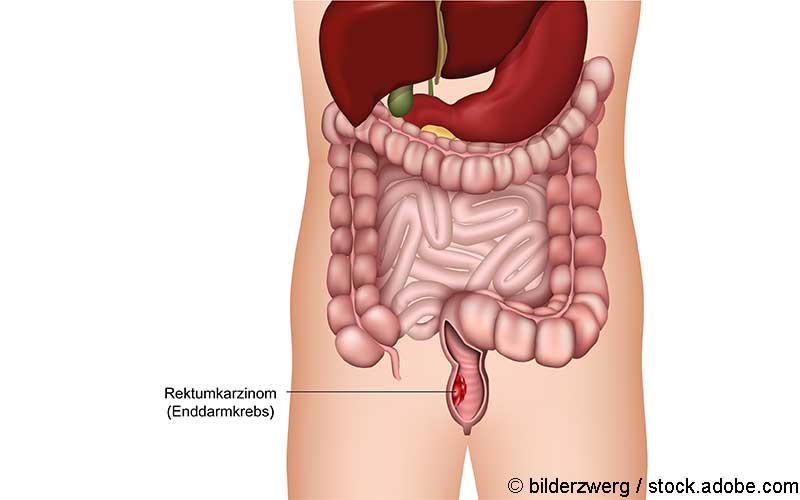 Rektumkarzinom