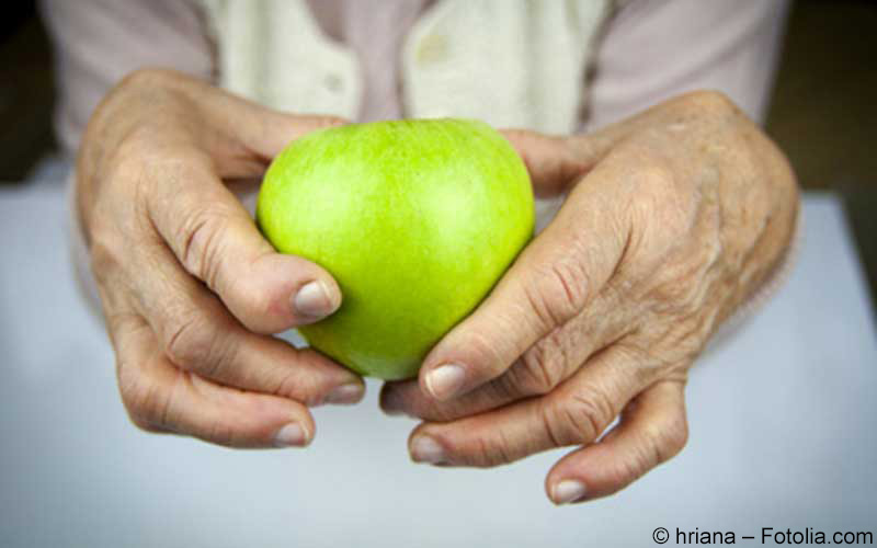 Rheumatische Hand Rheumatische Hand