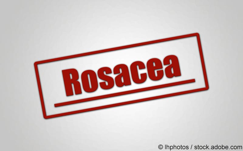 Rosacea Schriftzug Rosacea Schriftzug
