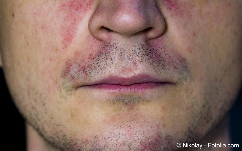 Rosacea Rosacea