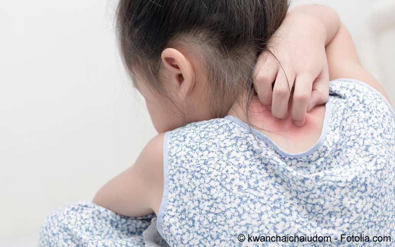 Schuppenflechte beim Kind Schuppenflechte beim Kind