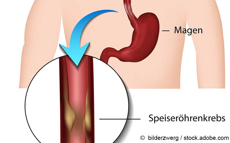 Speiseroehrenkrebs