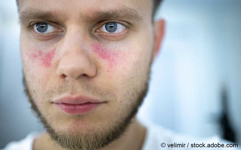 Systemischer Lupus erythematodes (SLE)