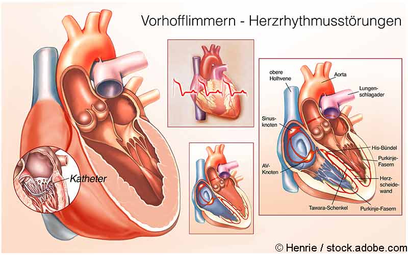 Vorhofflimmern Herz