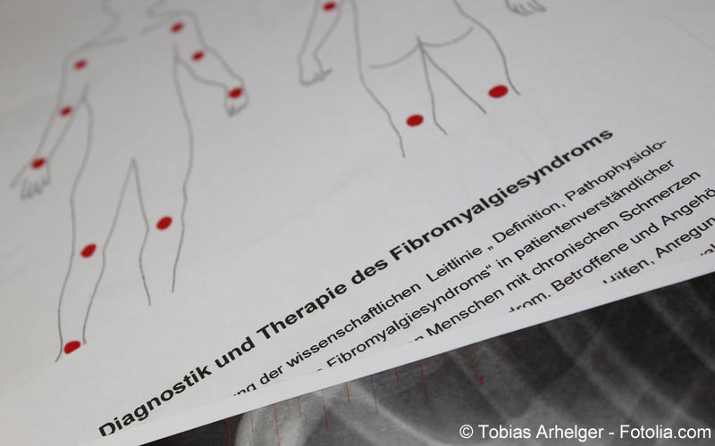 Fibromyalgie Fibromyalgie