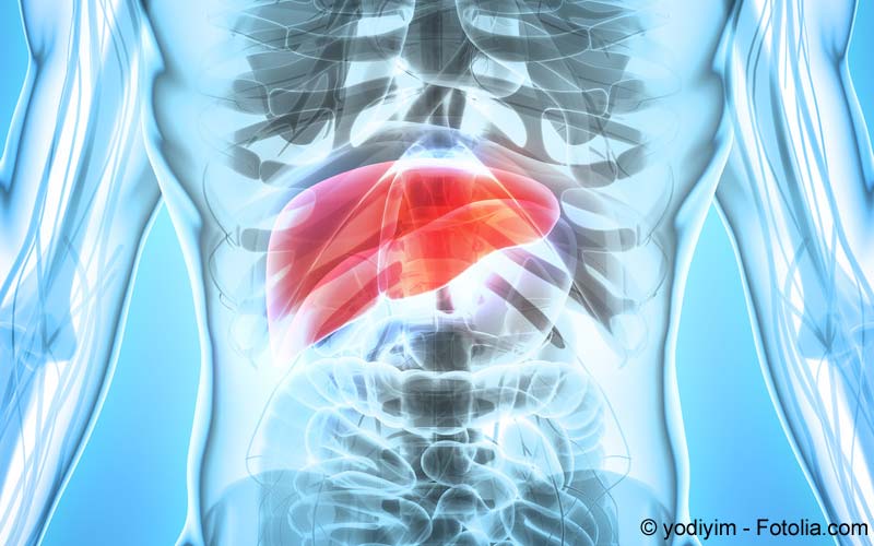 Hepatozelluläres Karzinom Hepatozelluläres Karzinom