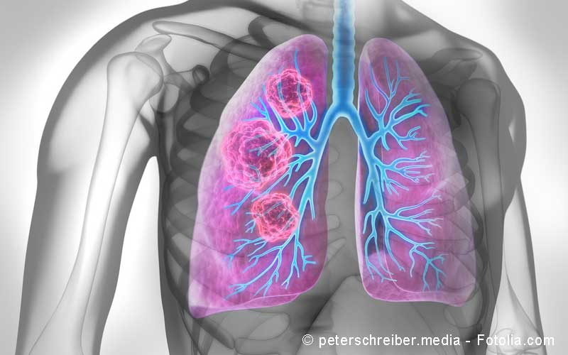 Bronchialkarzinom Lungenkrebs Symptome Diagnostik Therapie Gelbe Liste