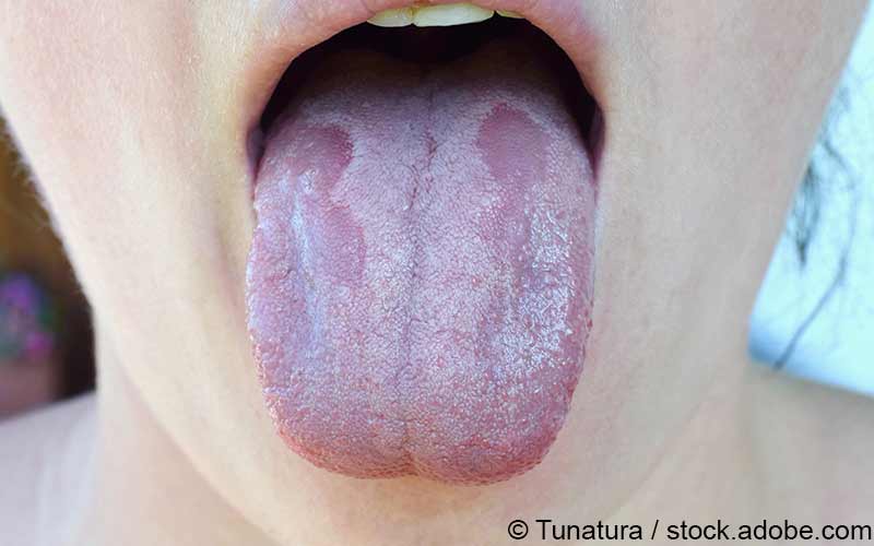Zungenbelag weiße Belegte Zunge