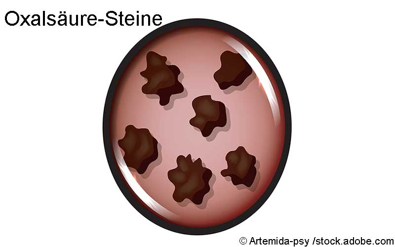 Oxalsäure Steine