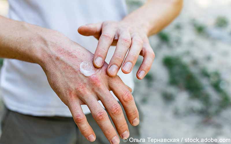 Patient AD Emollentien